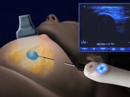 Κρυοπηξία – Cryoablation