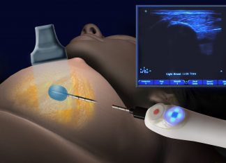 Κρυοπηξία – Cryoablation