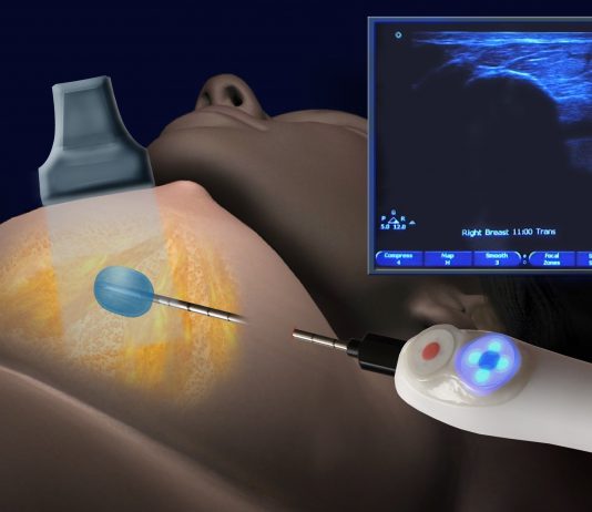 Κρυοπηξία – Cryoablation