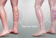 Κιρσοί κάτω άκρων