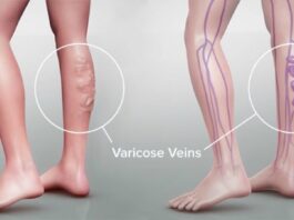 Κιρσοί κάτω άκρων