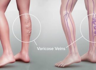 Κιρσοί κάτω άκρων