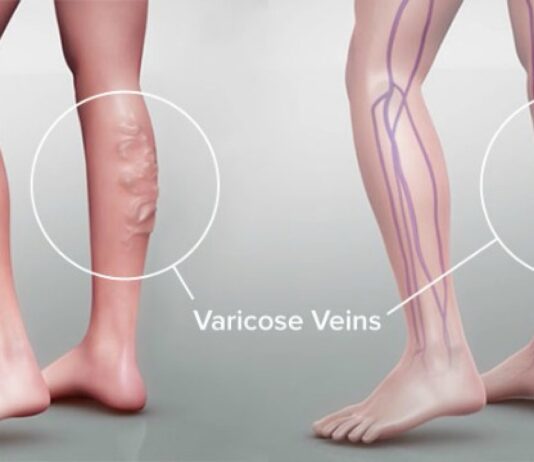 Κιρσοί κάτω άκρων