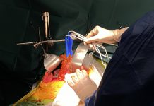 Nanoknife – IRE (irreversible electroporation)