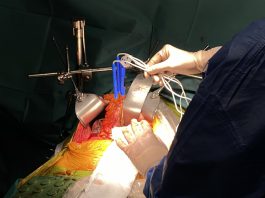 Nanoknife – IRE (irreversible electroporation)