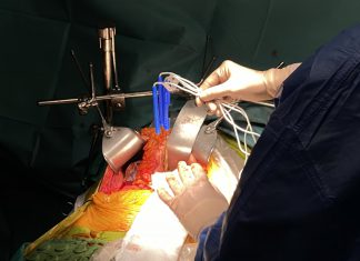 Nanoknife – IRE (irreversible electroporation)