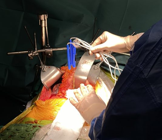 Nanoknife – IRE (irreversible electroporation)