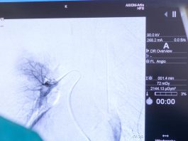 Χημειοεμβολισμός ήπατος – TACE