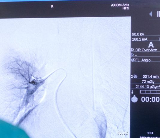 Χημειοεμβολισμός ήπατος – TACE