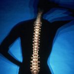 Osteoporosis1