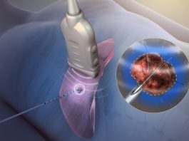 RF Ablation – Θερμοκαυτηρίαση όγκων