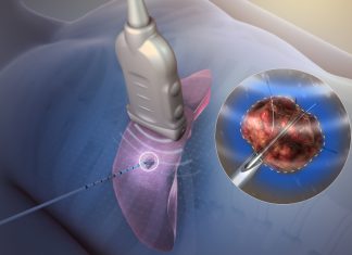 RF Ablation – Θερμοκαυτηρίαση όγκων