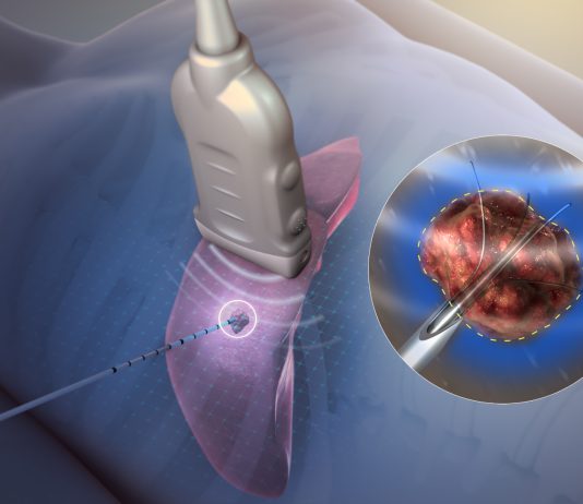 RF Ablation – Θερμοκαυτηρίαση όγκων