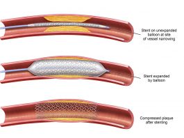Αγγειοπλαστική με μπαλόνι ή stent angioplasty