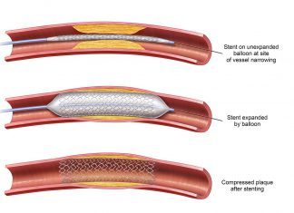 Αγγειοπλαστική με μπαλόνι ή stent angioplasty