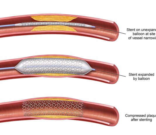 Αγγειοπλαστική με μπαλόνι ή stent angioplasty