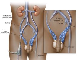 Κιρσοκήλη – Υπογονιμότητα varicocele