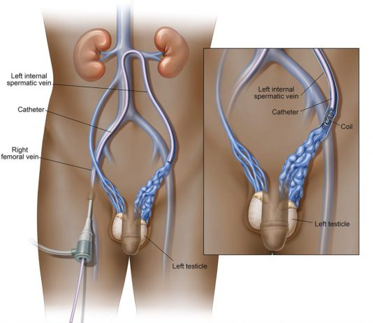 Κιρσοκήλη – Υπογονιμότητα varicocele