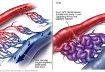 Αρτηριοφλεβώδης επικοινωνία νεφρού