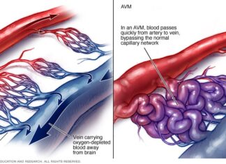 Αρτηριοφλεβώδης επικοινωνία νεφρού