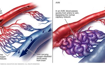 Αρτηριοφλεβώδης επικοινωνία νεφρού