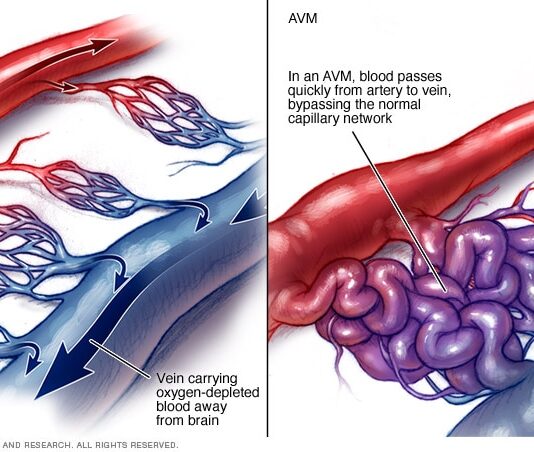 Αρτηριοφλεβώδης επικοινωνία νεφρού