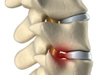 Κήλη μεσοσπονδύλιου δίσκου – Οσφυαλγία