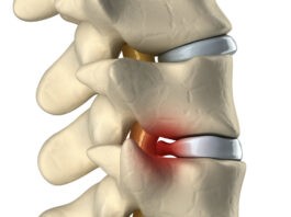 Κήλη μεσοσπονδύλιου δίσκου – Οσφυαλγία