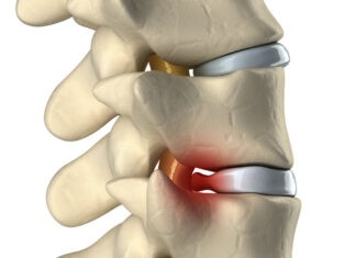 Κήλη μεσοσπονδύλιου δίσκου – Οσφυαλγία