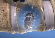 Σπονδυλοπλαστική – Vertebroplasty