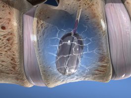 Σπονδυλοπλαστική – Vertebroplasty