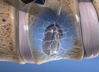 Σπονδυλοπλαστική – Vertebroplasty