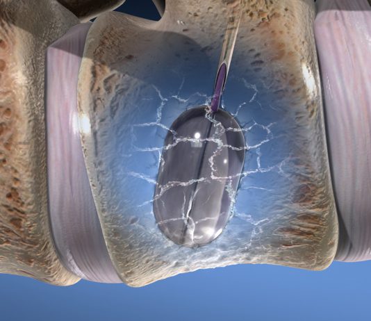 Σπονδυλοπλαστική – Vertebroplasty