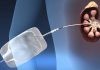 Νεφροστομία – Ουρητηρικό stent