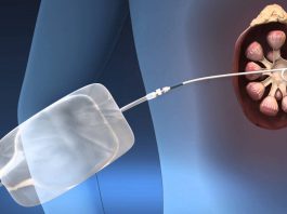 Νεφροστομία – Ουρητηρικό stent