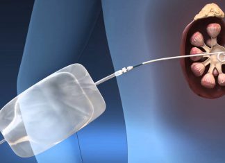 Νεφροστομία – Ουρητηρικό stent