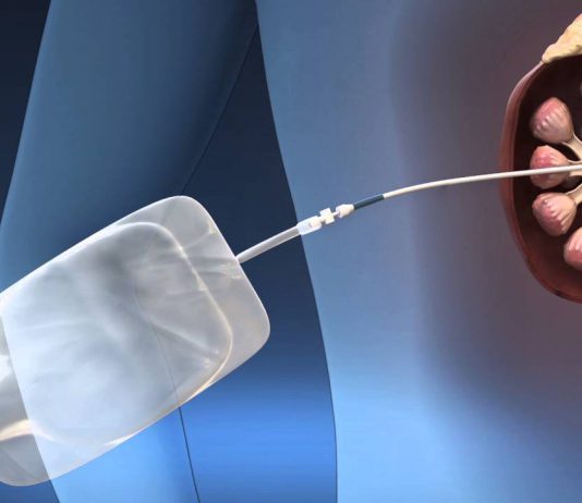 Νεφροστομία – Ουρητηρικό stent