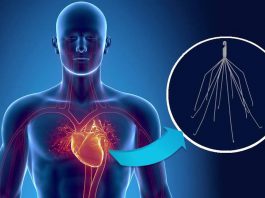 Φίλτρο κάτω κοίλης φλέβας