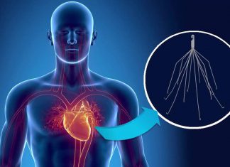 Φίλτρο κάτω κοίλης φλέβας