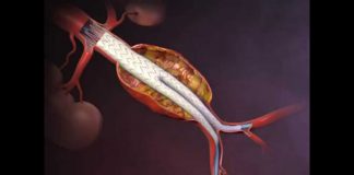 Ανεύρυσμα κοιλιακής αορτής (EVAR)