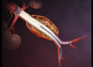 Ανεύρυσμα κοιλιακής αορτής (EVAR)