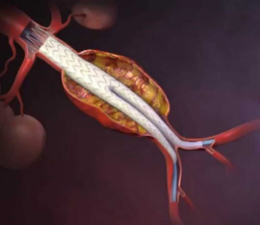 Ανεύρυσμα κοιλιακής αορτής (EVAR)