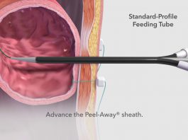 Γαστροστομία – Γαστρονηστιδοστομία