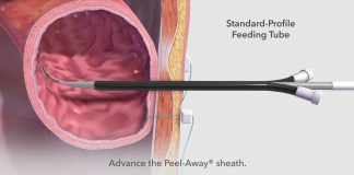 Γαστροστομία – Γαστρονηστιδοστομία