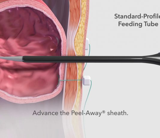 Γαστροστομία – Γαστρονηστιδοστομία