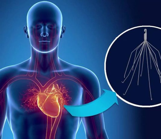 Φίλτρο κάτω κοίλης φλέβας