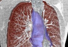 Εμβολισμός όγκου μεσοθωρακίου