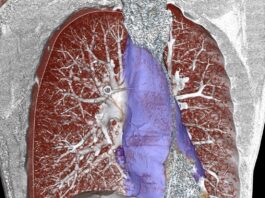 Εμβολισμός όγκου μεσοθωρακίου