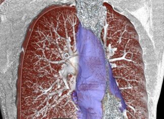 Εμβολισμός όγκου μεσοθωρακίου