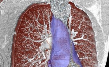 Εμβολισμός όγκου μεσοθωρακίου